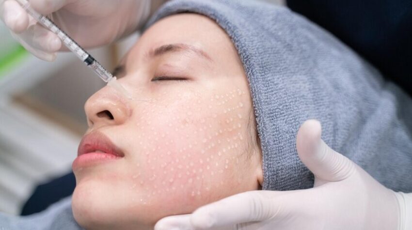 Micro-Needling